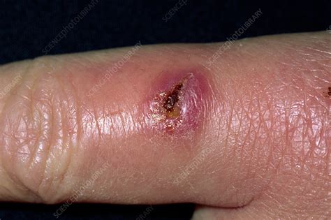 Finger Cut Infection