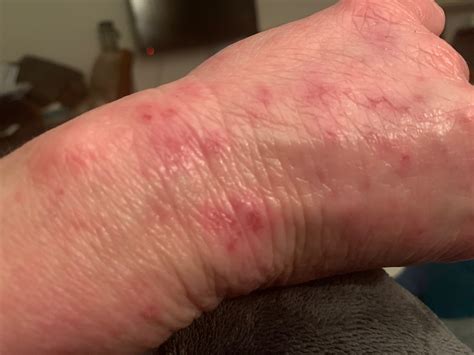 Sudocrem Stockpiling due to hand eczema | What Allergy Blog