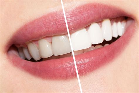 Teeth Whitening Dental Work at Harold Clarke blog