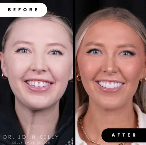 Veneers: The Ultimate Smile Transformation