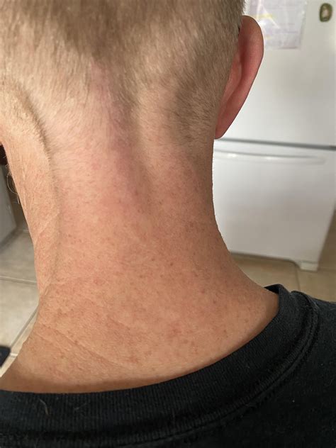 Dermatitis? Skin rash? Flare up? : r/DiagnoseMe