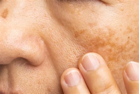 understanding skin pigmentation   influences oasis