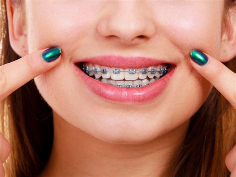 How Braces Can Correct Overcrowding, Crooked Teeth, and Gaps | Smilebliss