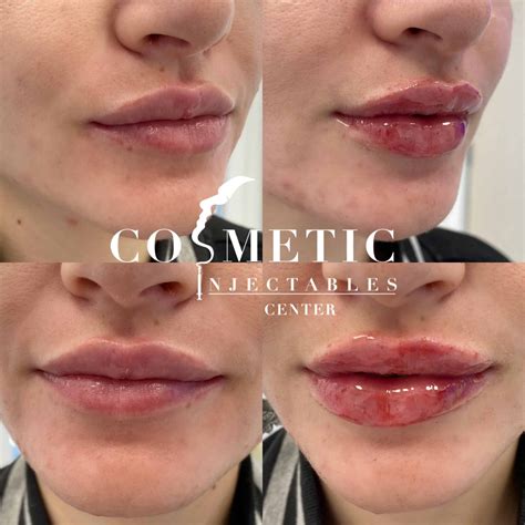 restylane lip filler 9