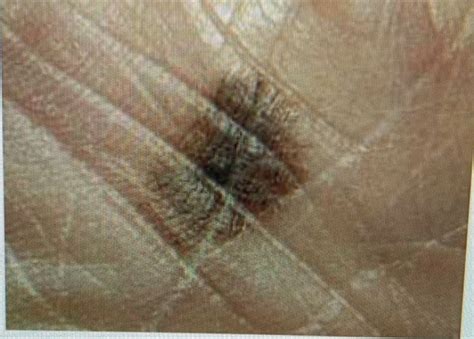 acral lentiginous melanoma   common melanoma  skin  color