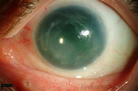 Aniridia