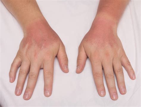 Itchy Skin From Sun Exposure at Andrew Godina blog