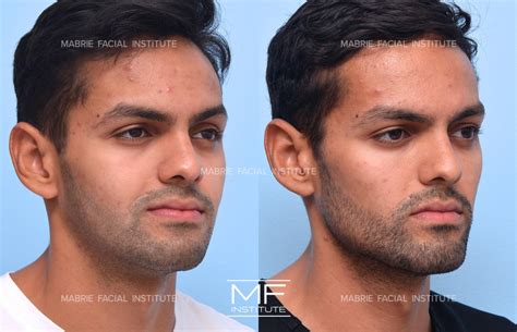 jawline filler  men transformative     mabrie