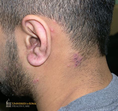 Grouped cloudy vesicles, some with central heme crusting, along the C3