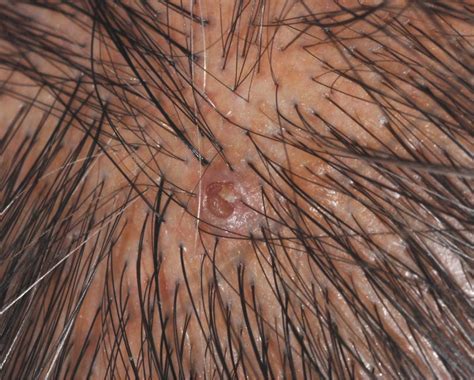 Umbilicated Keratotic Papule on the Scalp | MDedge Dermatology