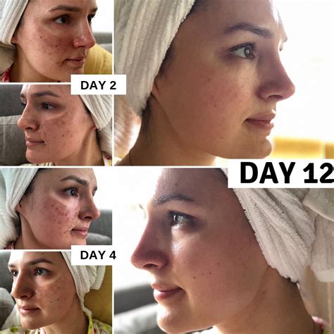 acid peel process satura blog