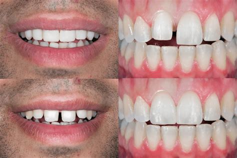 ultimate affordable dental veneers guide  san diego