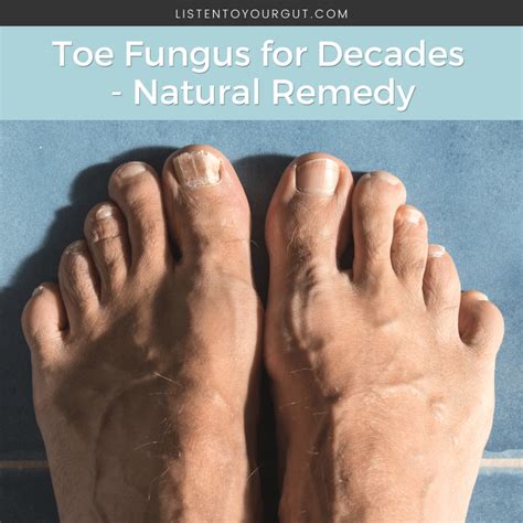 Toe Fungus for Decades - Natural Remedy | Listen To Your Gut