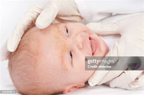 88 Seborrheic Dermatitis Stock Photos, High-Res Pictures, and Images ...