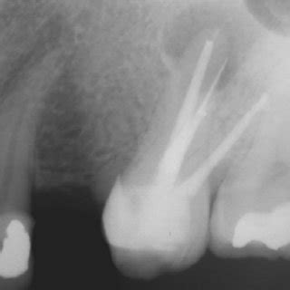 periapical radiograph  tooth ul  obturation