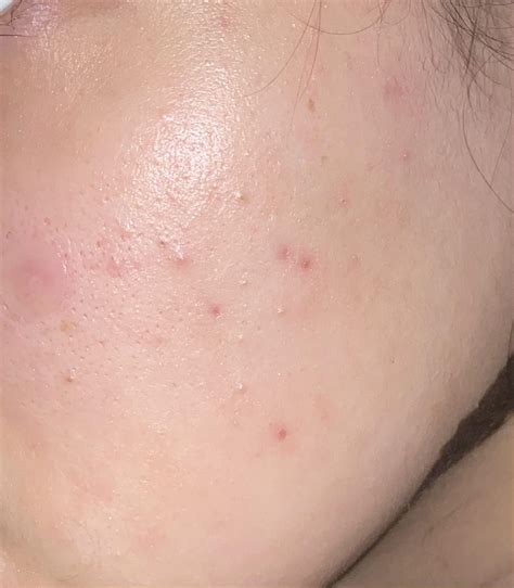 Are small pimples normal for a purge on tret? Or is this from using a ...