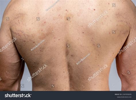 tinea versicolor  male  pityriasisanh  san shutterstock