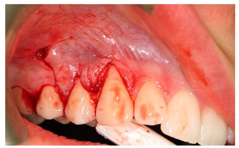 laterally positioned flap procedure  augmented  nonaugmented