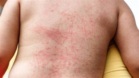 Dengue E Coceira No Corpo