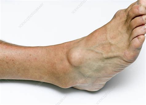 ganglion cyst  ankle stock image  science photo library