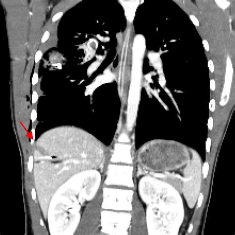 Chest radiography exhibiting left diaphragmatic elevation, an indirect ...