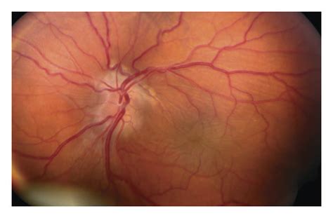 typical ultrasonographic  retinal features  nanophthalmos