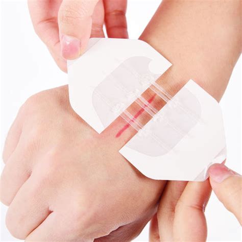medical adhesive wound closure device wound closure device wound