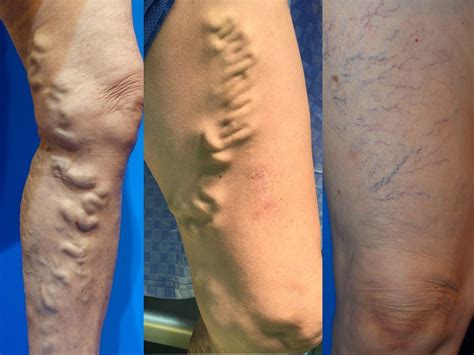varicose veins  symptoms    treat   varicose