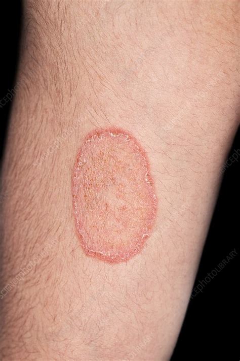 Ringworm Stock Image M2700223 Science Photo Library - vrogue.co