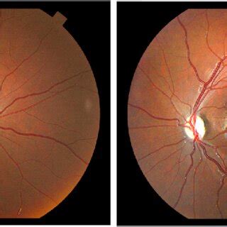 optic disc   proband case  showing small optic discs