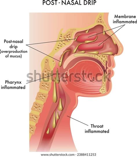 Mucus Throat: Over 629 Royalty-Free Licensable Stock Illustrations ...