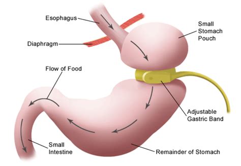 bariatric surgery cost  india bariatric weight loss surgery cost