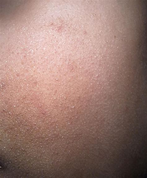 Bumps on my face : r/OnlineDermatologist