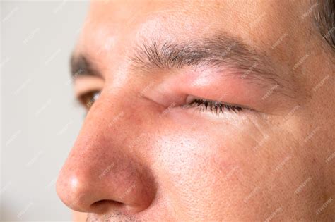 Premium Photo | A red swollen eyelid on a man's face in closeup is an allergy to an insect bite ...