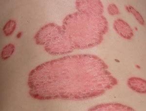 Plaque Psoriasis Information - Plaque psoriasis info - Symptoms, diagnosis, treatment