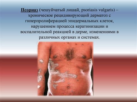 Псориаз (чешуйчатый лишай, psoriasis vulgaris) - online presentation