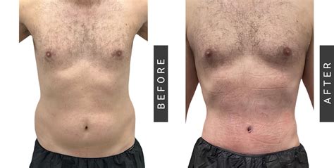 Lipo 360 Antes E Depois - Male Liposuction NYC - Lipo Surgery for Men in Manhattan & Bronx