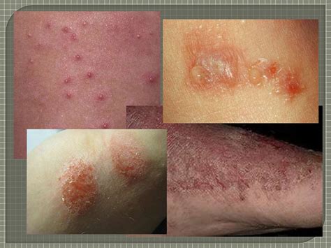 Экзема (eczema; греч. ekzema высыпание на коже) - презентация онлайн