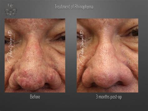 Rhinophyma Archives - New Orleans Premier Center for Aesthetics and ...