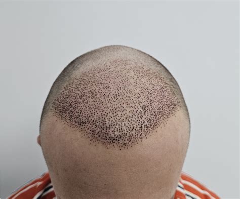 vitamin  deficiency  hair loss whats  connection hair