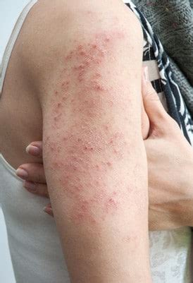 Skin Rashes Treatment Los Angeles CA - Tower Dermatology