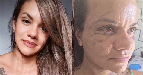 Como Ficou O Rosto Da Mulher Que Levou 60 Socos - Mulher agredida com 60 socos mostra o rosto após cirurgia, veja a foto ...