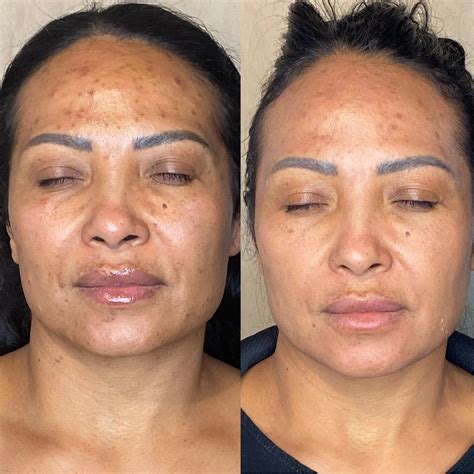 acne facial treatment benefits  hugo jenyns blog
