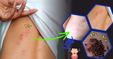 menghilangkan kutu kasur  badan yg  gigit kutu kasur