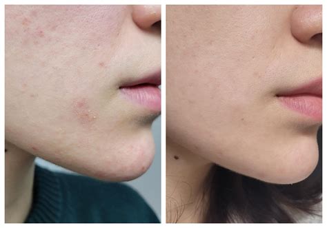 How Do You Reduce Lactic Acid in Your Body Fast?