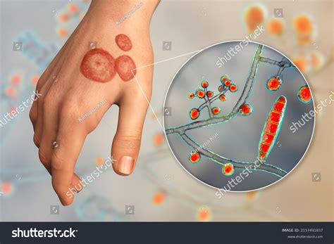 Fungal Infection On Human Hand Ringworm Stock Illustration 2157491837 ...