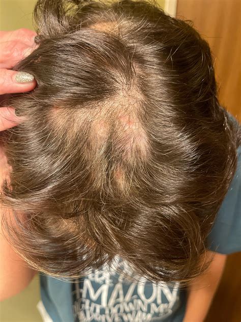 Atopic Dermatitis - scalp eczema : r/eczema