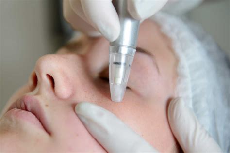 Microdermabrasion - Skin Exfoliating Treatment in Boston, MA