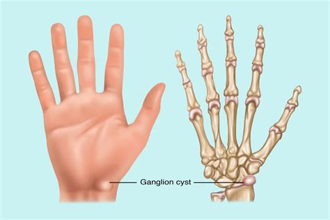 Ganglion Cyst, Illustration Poster Print by Gwen Shockey/Science Source ... 