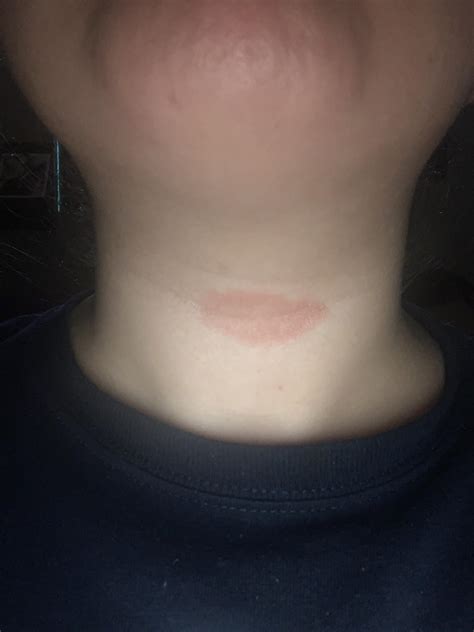 Nummular eczema? : r/DermatologyQuestions